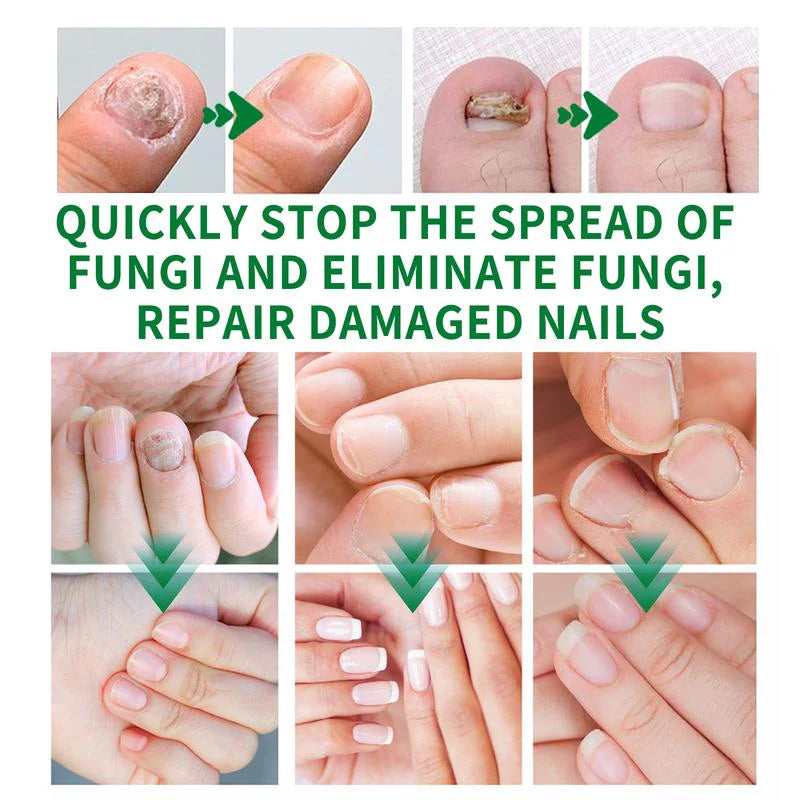 🚀Best - seller alert! AQA™ Ginger Nail Repair Series. Free shipping to your home for orders over 3 items 🚚, with up to 70% price cut 💰. A must - have for nail care!